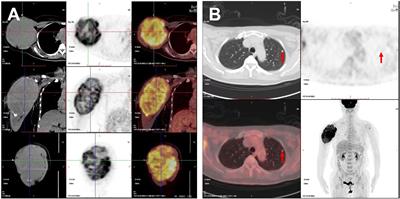 Papillary thyroid microcarcinoma with contralateral large humerus metastasis and cervical lymph node metastasis: A case report